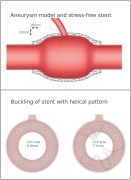Top: Aneurysm with covering stent. Bottom left: no stent buckling if stent cell size is large enough; Bottom right: Helical stent buckling