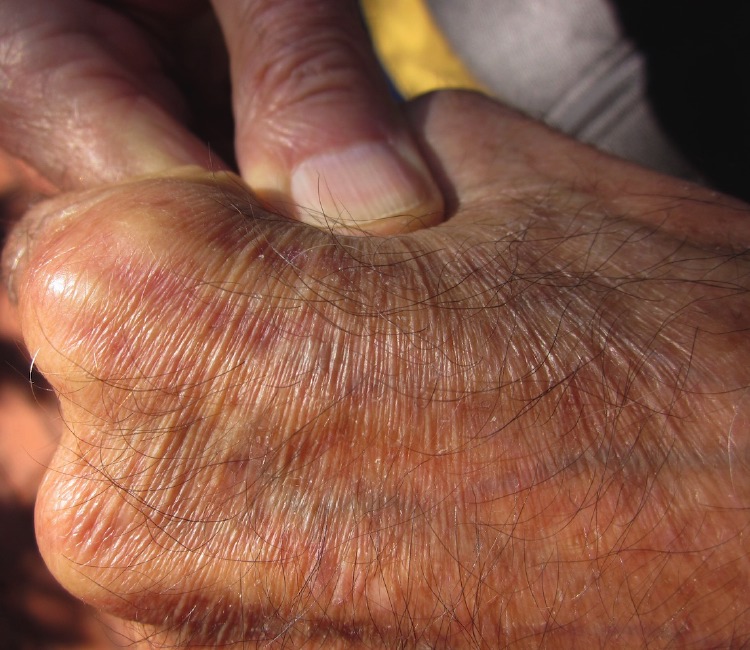 Tiny wrinkles on the back of David Bushnell's hand, which appear when the skin is put into tension along the wrinkles